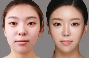 Hình ảnh khách hàng trước và sau khi phẫu thuật chỉnh sửa dáng mũi hếch 