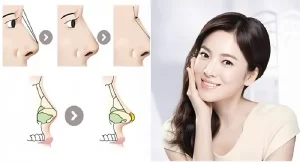 Nâng mũi đặt sống giúp mũi cao, thon gọn và hài hoà hơn với khuôn mặt