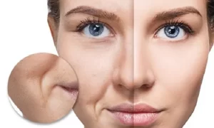Rãnh cười không nhận được sự yêu thích của chị em phụ nữ bởi nó được xem là dấu hiệu của lão hoá và tuổi tác. 