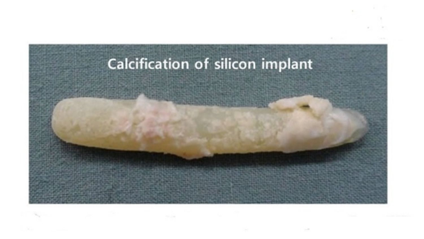 Sụn silicon và lớp xơ cứng vôi hóa sau khi được lấy ra
