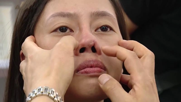 Tình trạng mũi bị xơ cứng