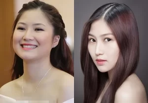 Hình ảnh khách hàng trước và sau khi sửa mũi to