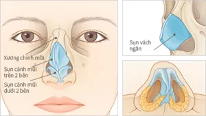 Nâng mũi bằng sụn vách ngăn