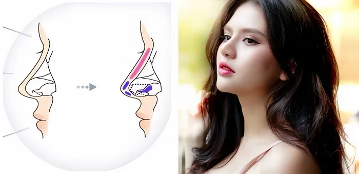 Quy trình nâng mũi S-line 3D cần được thực hiện theo một quy trình chuẩn y khoa
