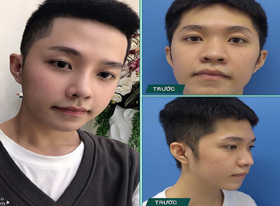 Nâng mũi cho nam tại Viện thẩm mỹ Đông Á
