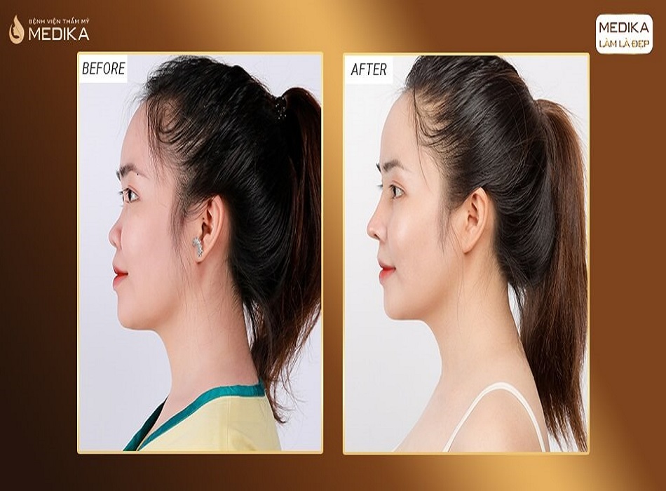 Hình ảnh nâng mũi chân thật đến từ khách hàng