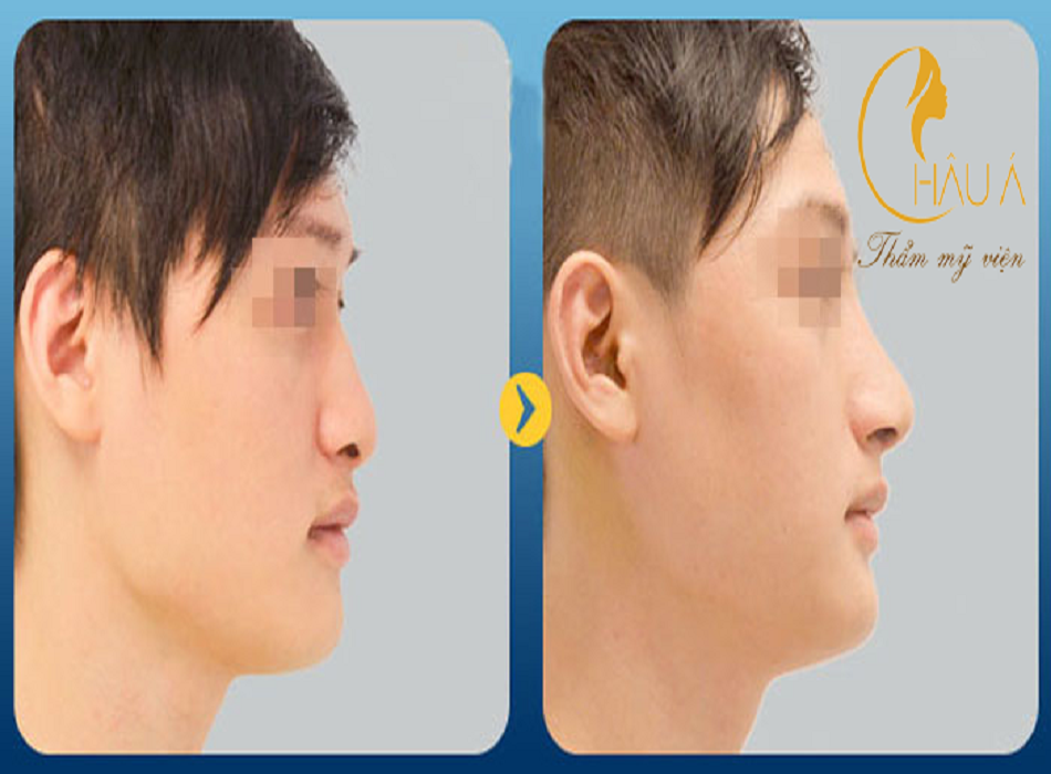 Hình ảnh khách nam trước và sau khi nâng mũi tại Châu Á