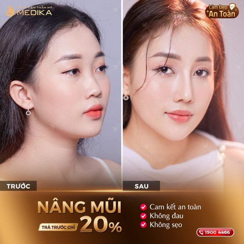 Nâng mũi trả góp tại Viện Thẩm Mỹ MEDIKA