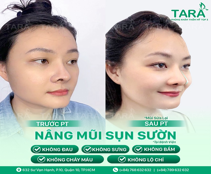 Nâng Mũi Sụn Sườn Cùng Bác sĩ Trang – Thẩm mỹ TARA CLINIC