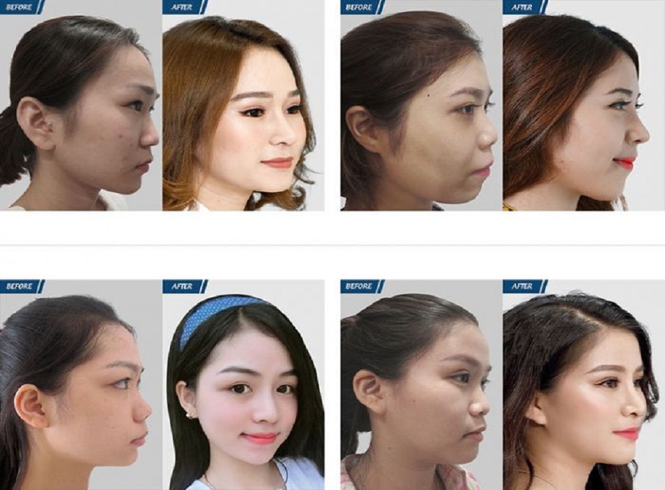Hình ảnh khách hàng khi nâng mũi tại Minhon
