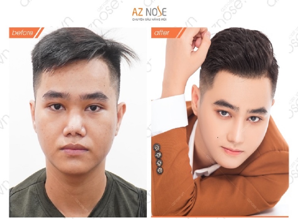 Khách nam thăng hạng nhan sác sau khi nâng mũi tại AZ NOSE