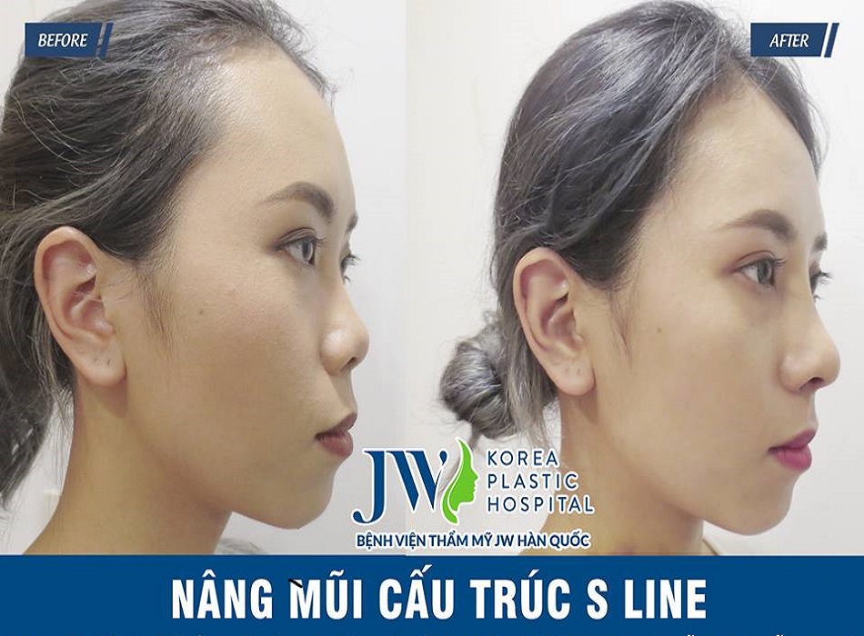 Hình ảnh nâng mũi trước - sau tại bệnh viện thẩm mỹ JW Hàn Quốc