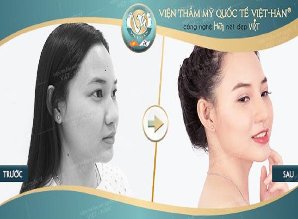 Khách hàng khi nâng mũi tại Viện thẩm mỹ Việt - Hàn