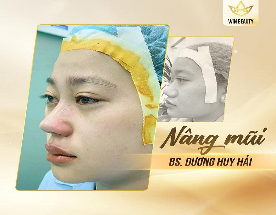 Nâng mũi tại Thẩm mỹ Quốc tế WIN
