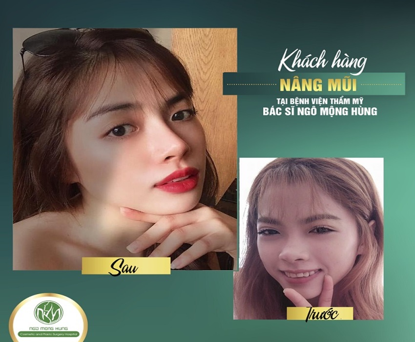 Hình ảnh khách hàng trước và sau khi nâng mũi sụn sườn tại Bệnh Viện Thẩm Mỹ Ngô Mộng Hùng