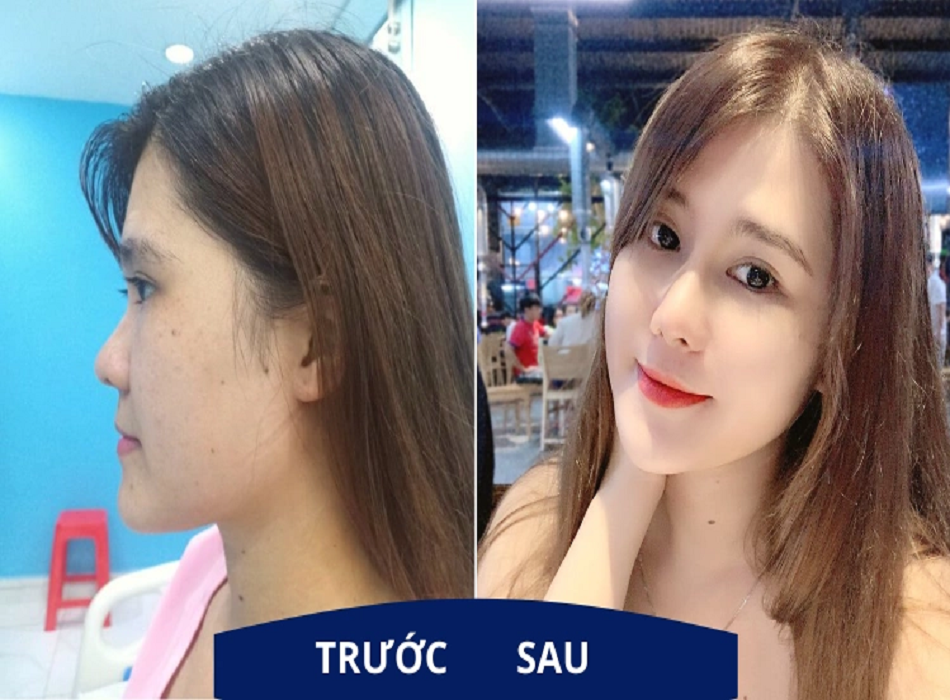 Hình ảnh của khách hàng trước và sau khi nâng mũi tại Annie