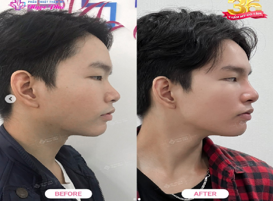 Khách hàng trước và sau khi nâng mũi tại Ngọc Phú