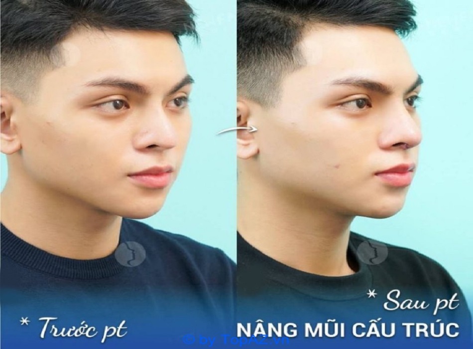 Nâng mũi nam tại Dr. Trần Phương
