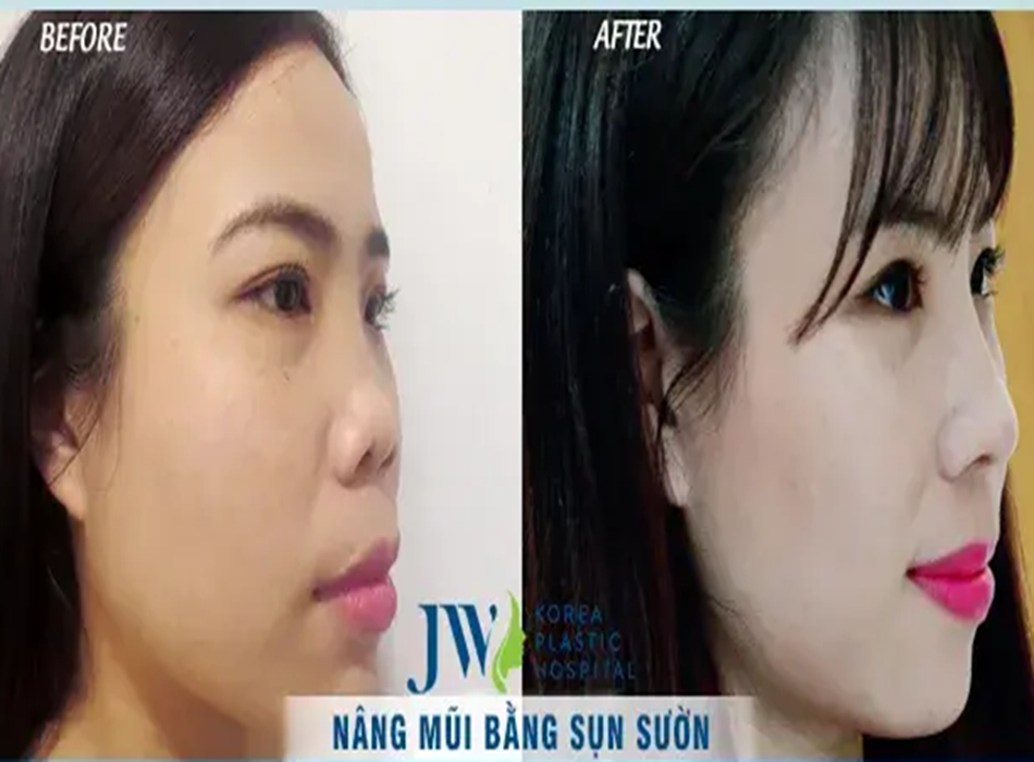 Hình ảnh từ khách hàng trước và sau khi nâng mũi sụn sườn tại JW