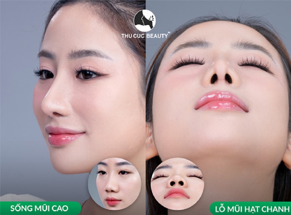 Khách hàng cực xinh đẹp khi nâng mũi tại Thu Cúc