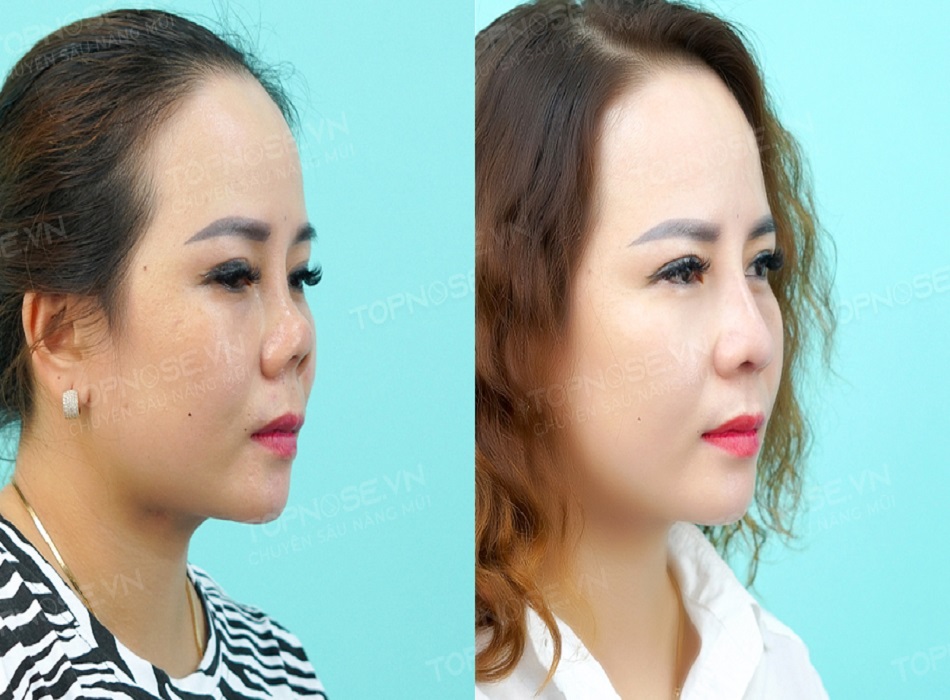 Khách hàng khi nâng mũi tại Topnose