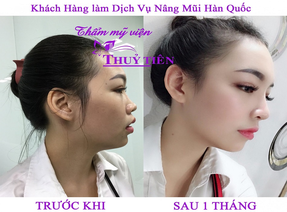 Bác sĩ tại Thủy Tiên sẽ tư vấn phương pháp phù hợp.
