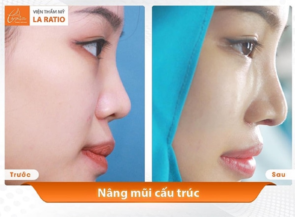 Khách hàng trước và sau khi nâng mũi cấu trúc tại La Ratio