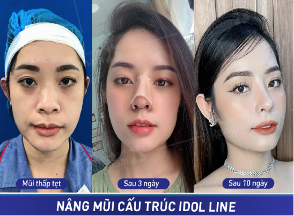 Khách hàng khi nâng mũi cấu trúc Idol Line tại Kangnam
