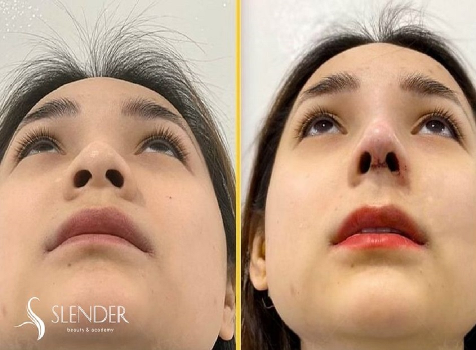 Nâng mũi là một trong những dịch vụ thế mạnh của Slender Beauty