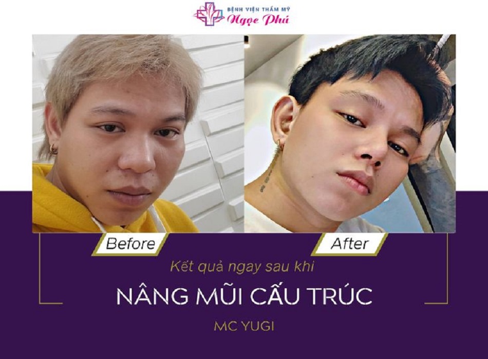 Hình ảnh MC YUGI nâng mũi cấu trúc tại Ngọc Phú