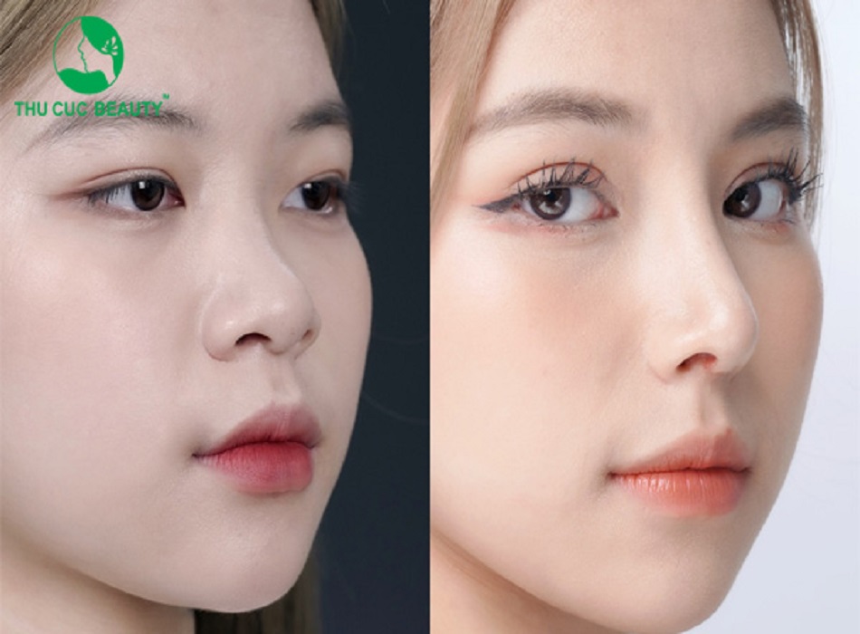 Hình ảnh trước và sau khi nâng mũi sụn sườn tại Viện thẩm mỹ Thu Cúc