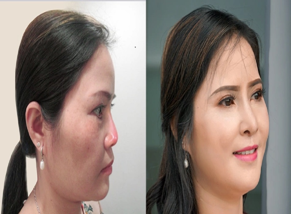 Bác sĩ Dũng đã khắc phục mũi lộ sóng, bóng đỏ.