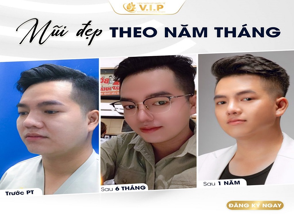 Hình ảnh khách nam khi nâng mũi tại VIP