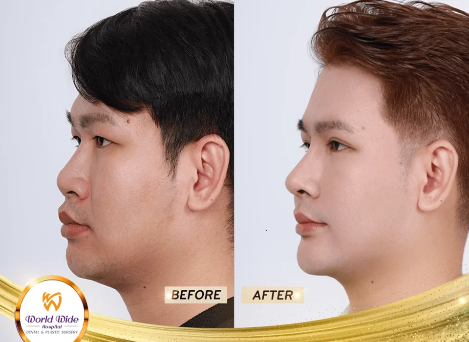 Hình ảnh trước và sau khi thẩm mỹ mũi