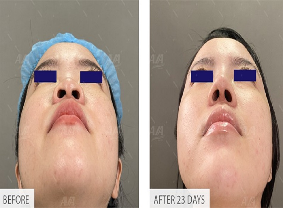 Khách hàng tôi trước và sau khi nâng mũi tại AVA