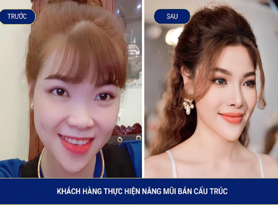 Kết quả nâng mũi của khách hàng khi được được Bác sĩ Lý Tấn Hiệp trực tiếp phẫu thuật