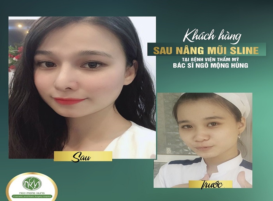 Khách hàng trước và sau khi nâng mũi tại Bác sĩ Hùng