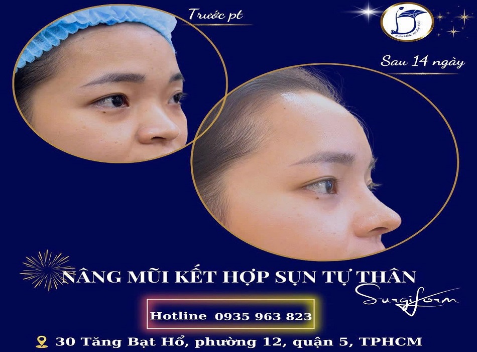 Khách hàng trước và sau khi nâng mũi tại Dr. Dương