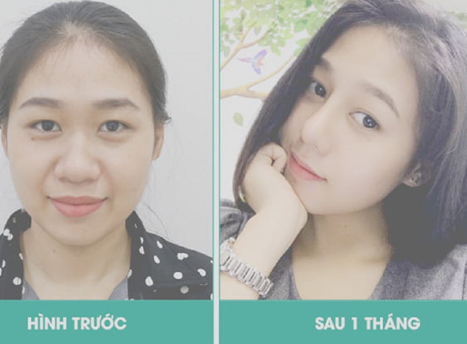 Khách hàng khi nâng mũi tại Bác sĩ Lương Ngọc sau 1 tháng