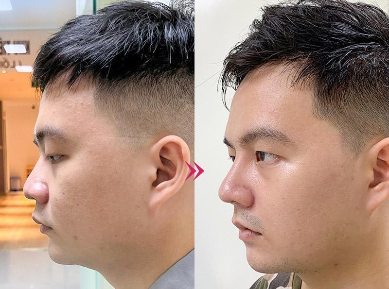 Nâng mũi cấu trúc sẽ giúp khắc phục tốt nhất các khuyết điểm trên mũi cho nam giới