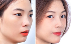 Mũi tẹt là một dạng mũi có đặc điểm sống mũi thấp, xương mũi to bè, đầu mũi lớn và lỗ mũi rộng